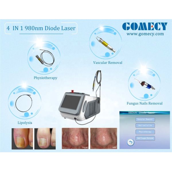 Клиническая лазерная машина для педикюра грибков ногтей, устраняющая ЛВД, утверждена