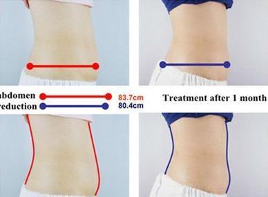 direct factory !!! high quality and competitive price Cryolipolysis Slimming Machine