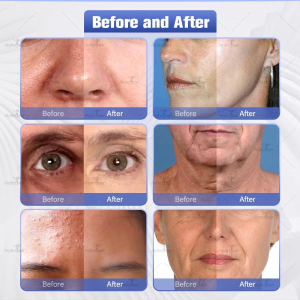 15 видов ручек Гидрафациальная косметическая машина с напряжением 100-240 В и вакуумом 100 КПа