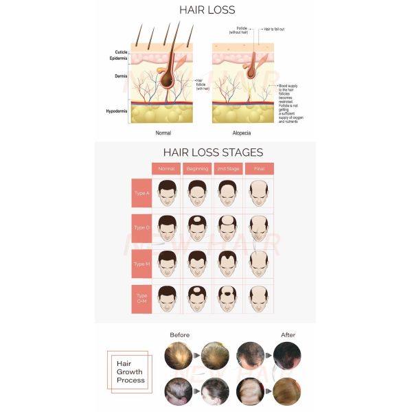 650nm Portable LLLT Laser Diodes Hair Regrowth Cap For Home Use