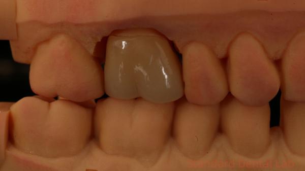 Mill and Centring Full Zirconia Crown , China Dental Lab Fast Delivery