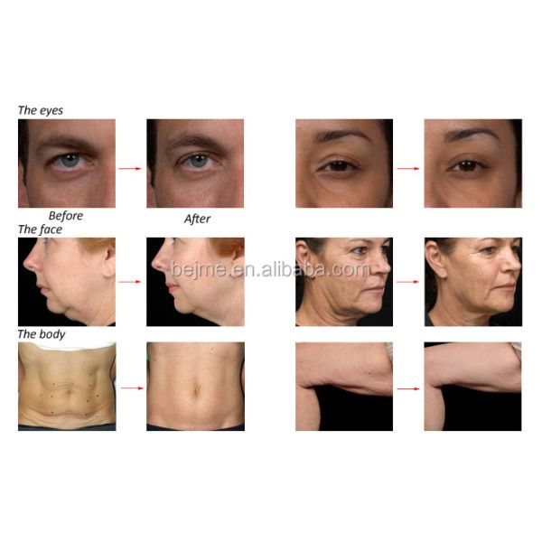 Commercial Radio Frequency Fat Melting Machine For Face / Skin Tightening