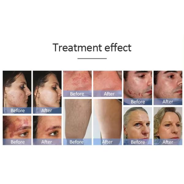 IPL OPT E-light Laser Hair Removal Permanent Machine 480nm 530nm 640nm