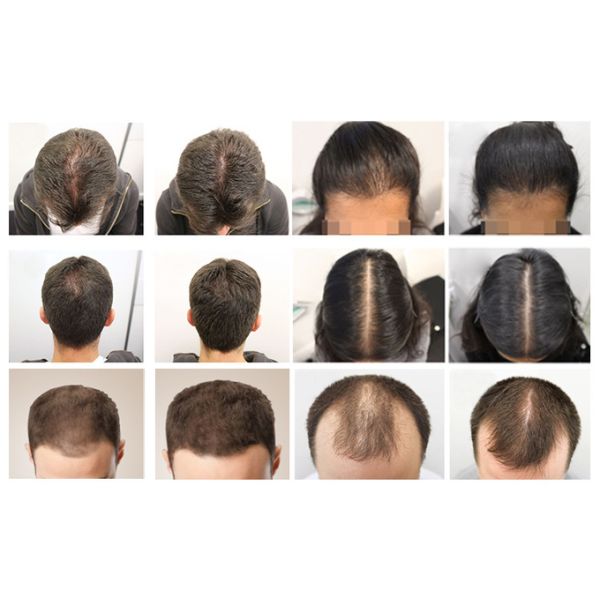 Professional 650nm LED Hair Growth System - Enhances Hair Regrowth & Scalp Health