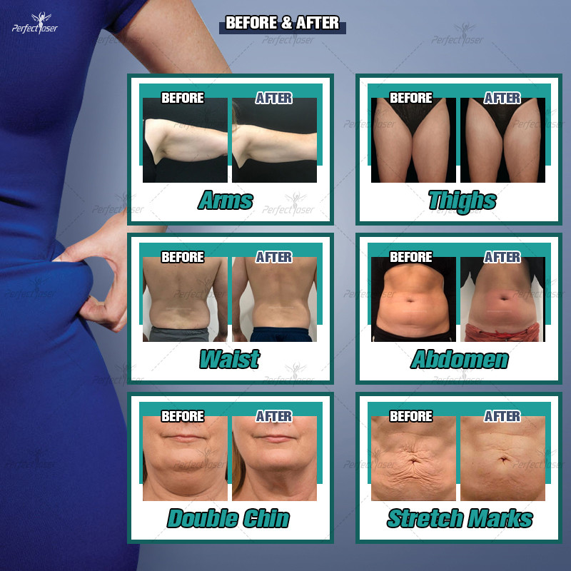 360 Cryolipolysis уменьшая потерю веса 0kpa Coolsculpting машины - 100kpa