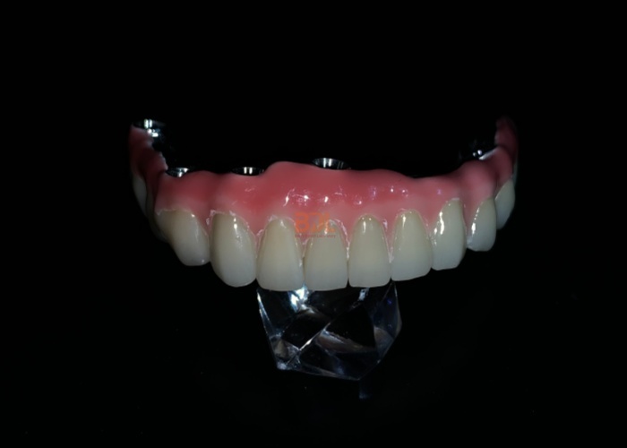 Durable Dental Implant Support Bar Featuring Superior Mechanical Properties for Effective Dental Prosthesis Integration