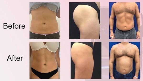 15 Tesla RF EMS Slimming Machine For Body Contouring / Muscle Strengthening