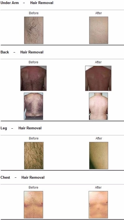Vasular уменьшает постоянную машину 2In1 лазера удаления волос