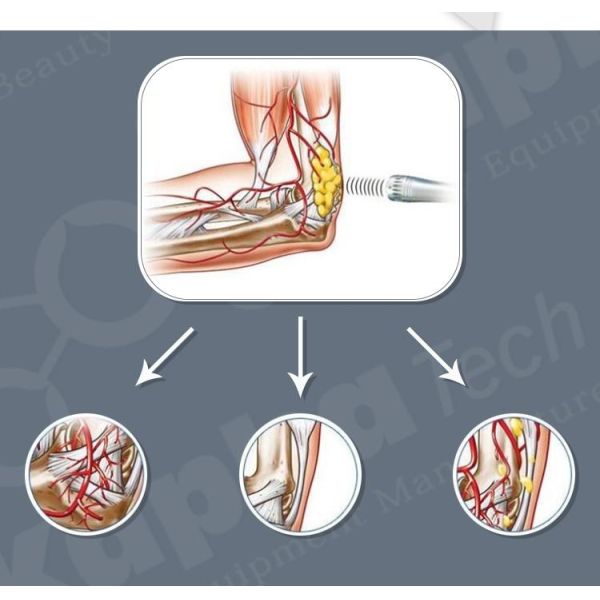 EMS Shockwave Therapy  5MJ Pain Treatment Machine