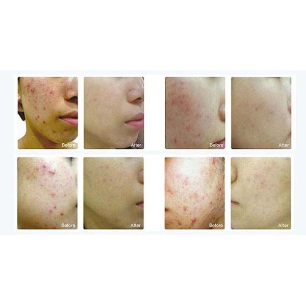 Professional Red Light Therapy PDT Equipment No Damage To Sub-Dermal Tissue