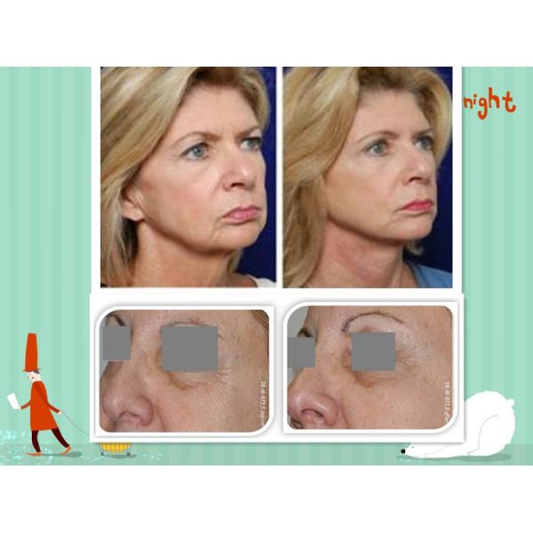 Painless SHR Bipolar RF Radio Frequency Skin Tightening Machine