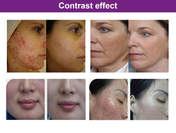 Equipamento da terapia do diodo emissor de luz da terapia da luz de Pdt para o tratamento da acne e a pele Whitening&Tightening