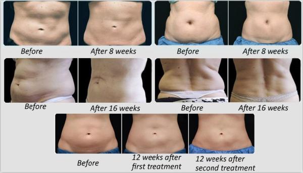 most advanced! best multifunctions rf & cavitation & Cryo & vacuum tech fat freezing device