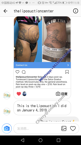 Power Assisted Surgical Liposuction Machine Abdominal Surgery Equipment