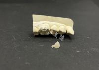 Incrustação cerâmica Emax hipoalergénica resistente a manchas para reparação precisa de dentes danificados