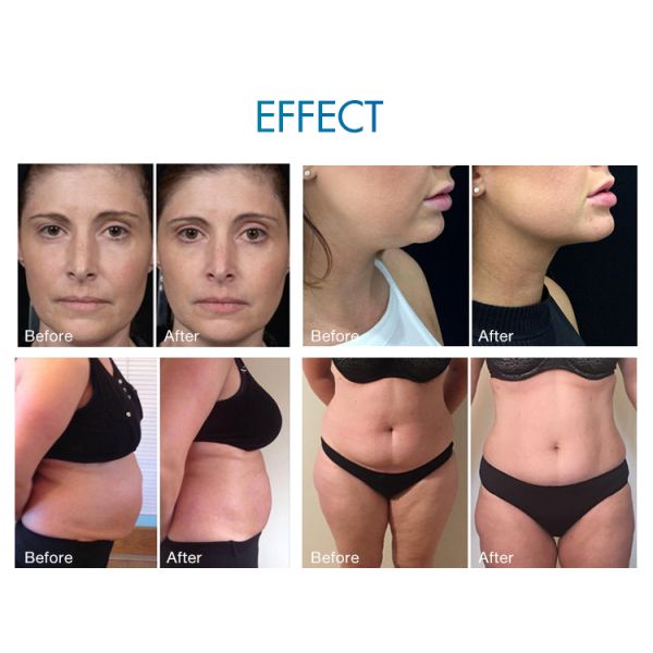 CET RET RF Vacuum Physiotherapy Body Slimming Skin Tightening Beauty Machine