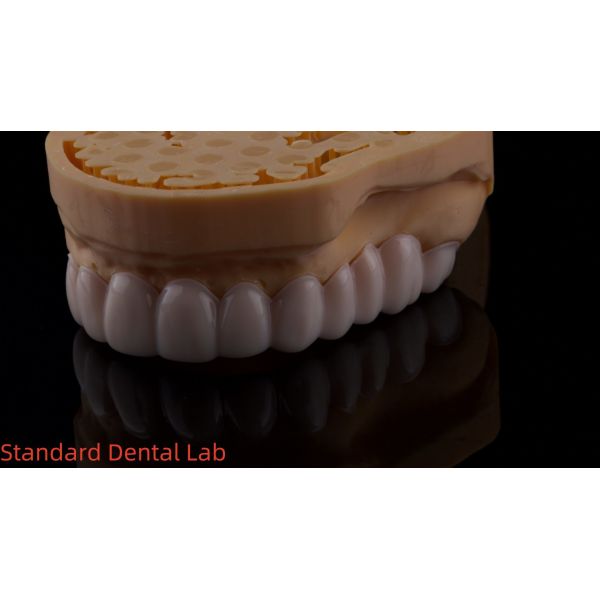 High Esthetics Dental Snap On Smile Standard Dental Lab Removable Dental Appliance
