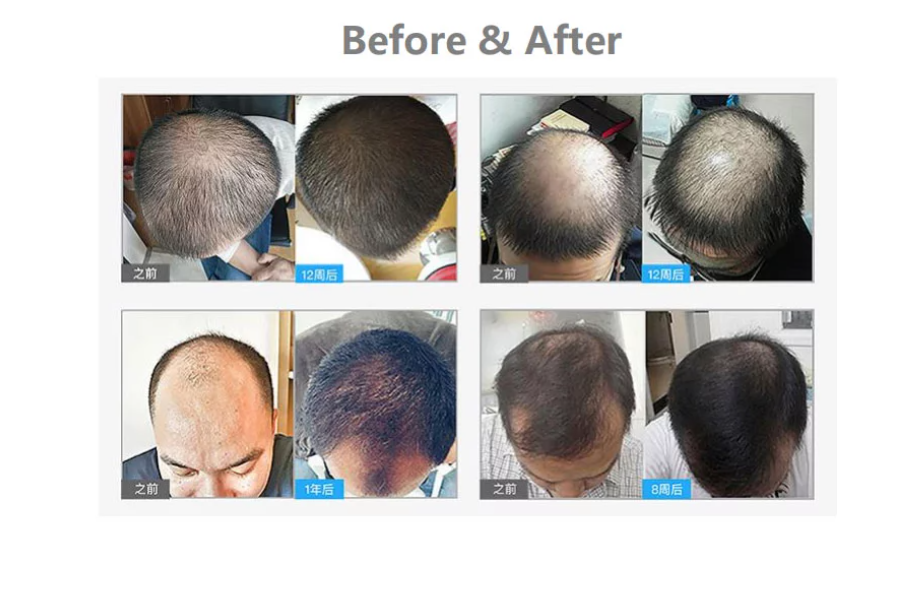 Photobiomodulation Therapy LLLT Hair Regrowth Cap 15W
