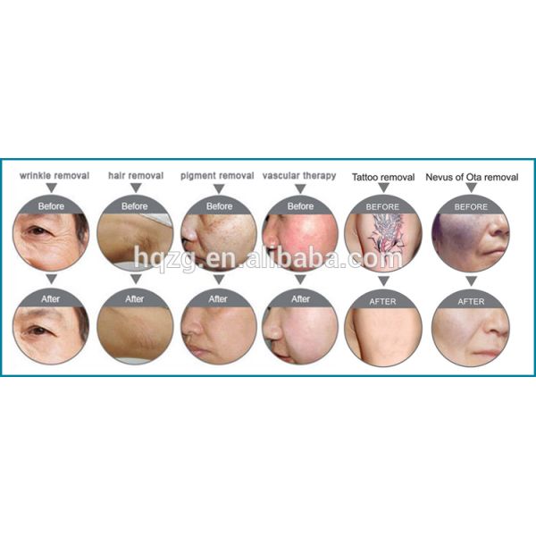Машина УС002Х красоты ИПЛ ИАГ РФ е светлая многофункциональная для удаления татуировки