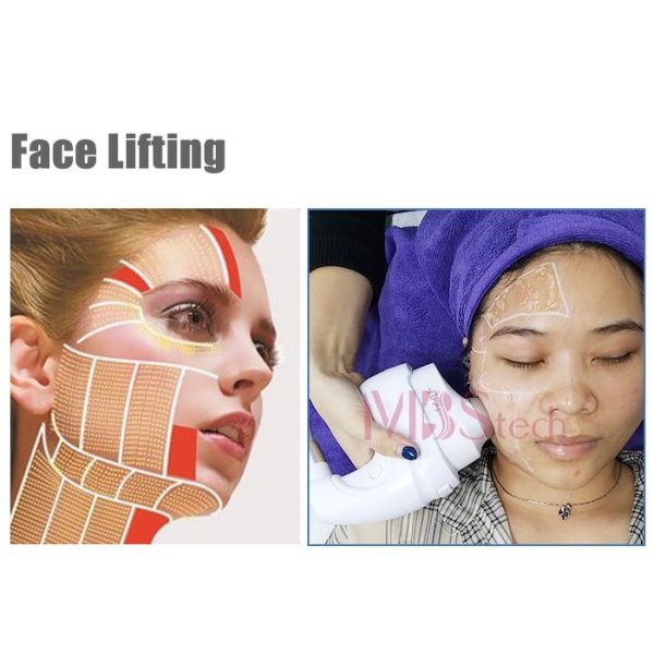 ЛЕД ультразвуковое Hifu утверждения 5D Управления по санитарному надзору за качеством пищевых продуктов и медикаментов для затягивать кожи