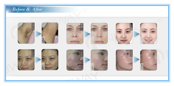 new hot safe and fast result 3 handles permanent hair removal IPL photofacial machine