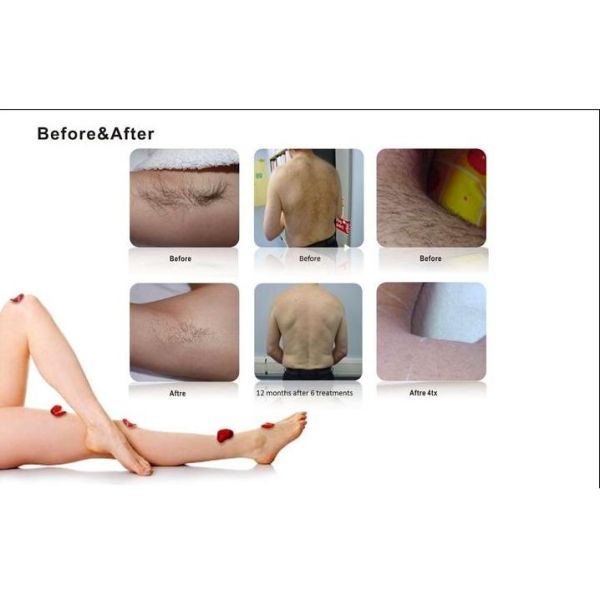 Amazing result 808nm Diode Laser Hair Removal beauty system   with  3 years warranty