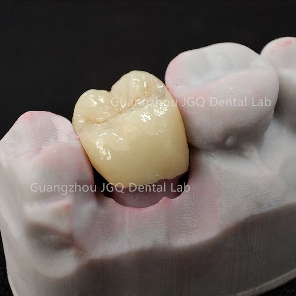 High Fracture Resistant Zirconia Crown Bridge CNC For Bruxism Heavy Occlusion