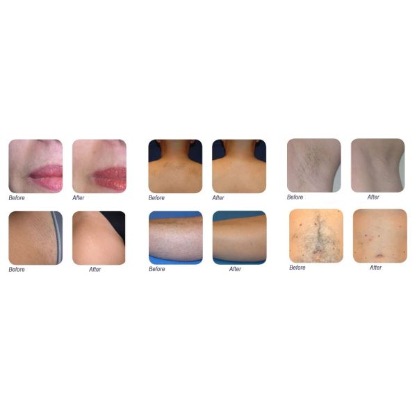 1064nm Long Pulse nd yag laser machine for lip , armpit , arms , legs Hair Removal