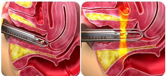 vaginal Co2 Fractional Laser Machine for vaginal tighten and skin rejuvenation