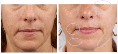 Skinject Hyaluronic Acid Pen Filler , 2ml Injectable Hyaluronic Acid Filler