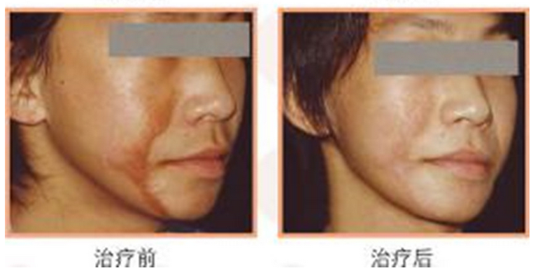 Professional Fractional Co2 Laser Machine For Head Hair Reborning OEM / ODM