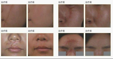 Best choice RF Metal Tube Acne scar removal Fractional Co2 Laser Machine