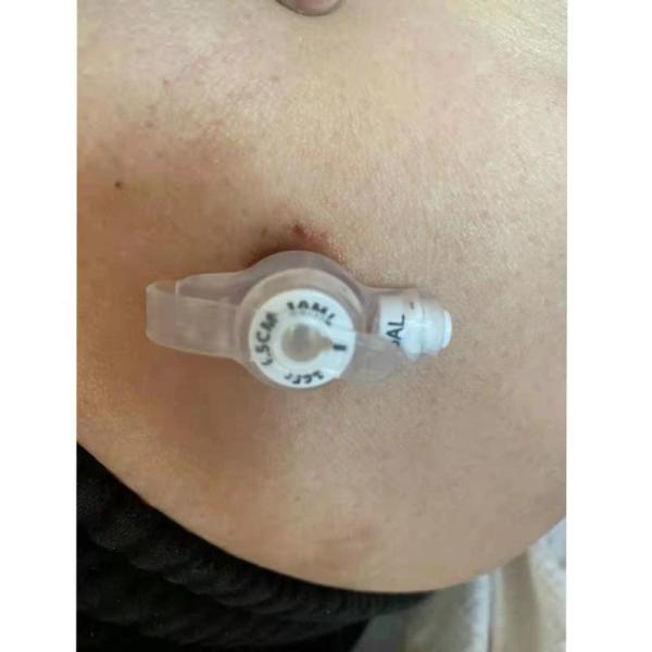 Sterile Silicone Disposable Endotracheal Tube Button Gastrostomy For Adult
