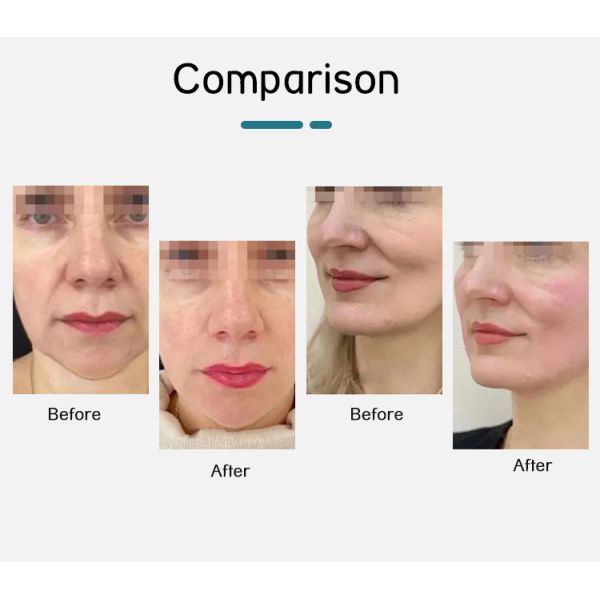 Appareil de beauté à ultrasons 220V-240V / machine de lifting facial Système de contourage du corps pour le commerce