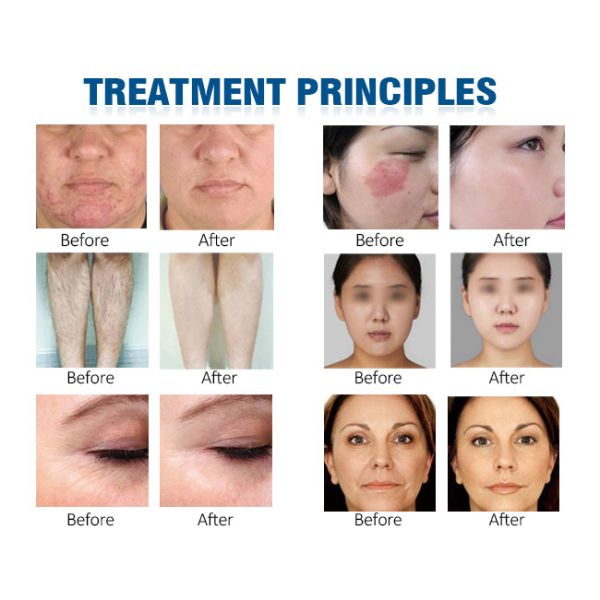 машина удаления волос лазера стороны лазера SHR 530nm 590nm Elight Ipl Rf