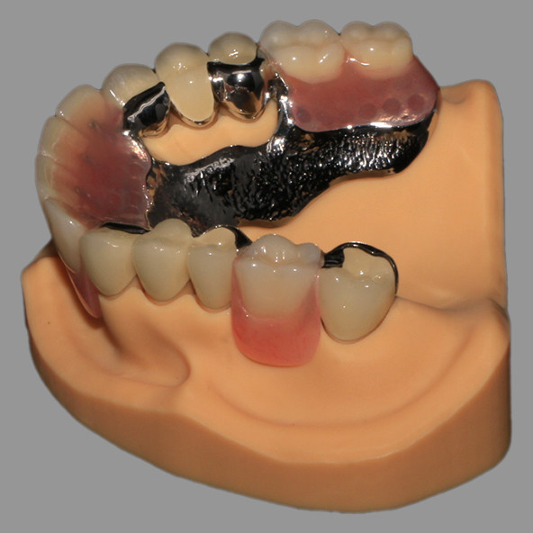 CoCr Acrylic Cast Metal Partial Combined With Fixed PFM