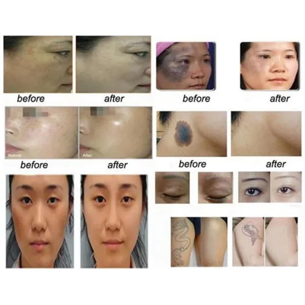 Newest Design Picosecond Laser Machine