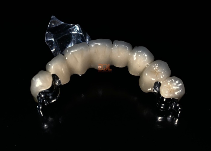 Durable Porcelain Fused To Metal Crown Dental Restoration Solution Ideal For Long Lasting Strength And Natural Appearance
