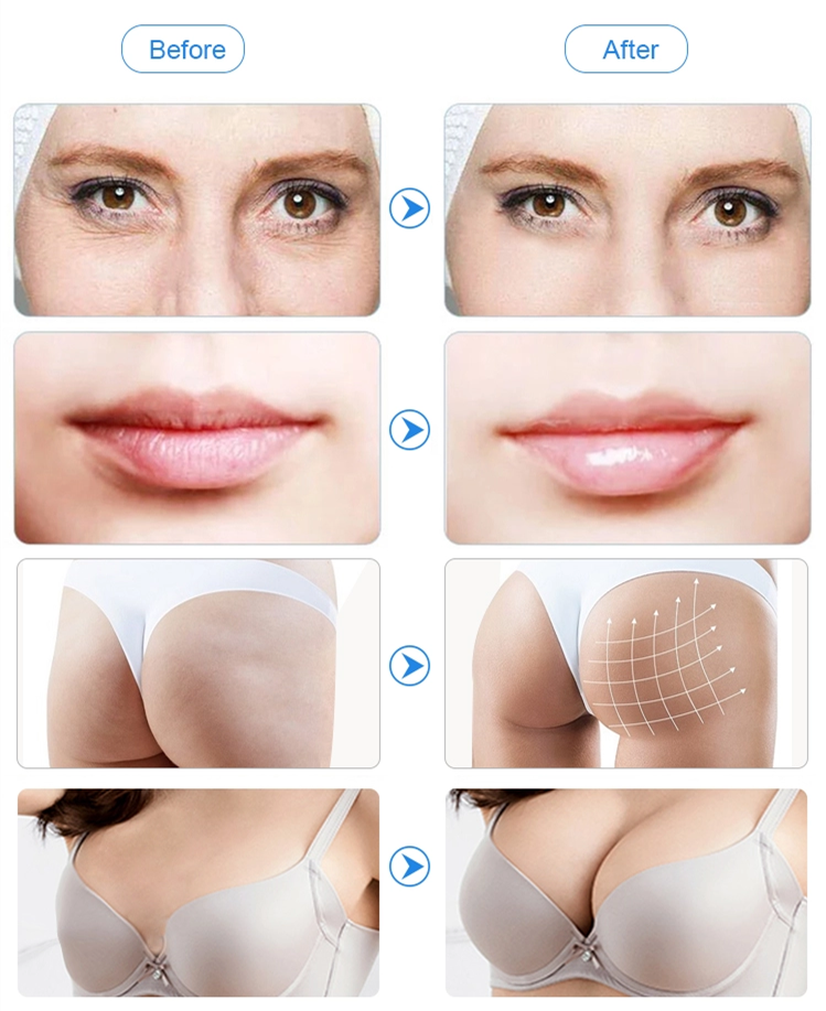 Room Temperature Preserved Transparent Hyaluronic Acid Filler Injections For Hypodermic Layers