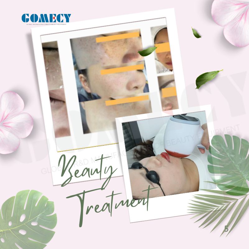 Dispositivo de depilación permanente con láser de diodo de 808nm/755 808 940 1064nm y color blanco