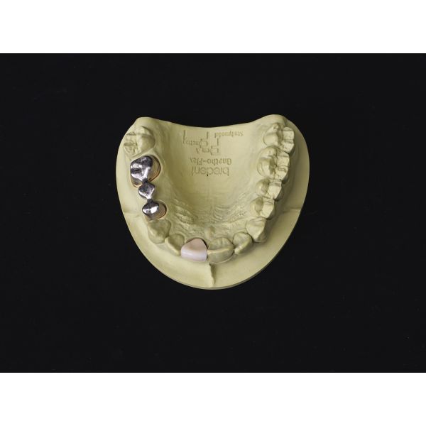 Audental 43 aleación de porcelana de plata y paladio Pd43% noble para restauraciones dentales fuertes y estéticas