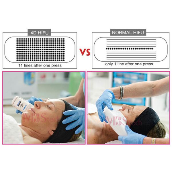 20000 Shots 11 Lines 8 Cartridges 4D Hifu Face Lift Machine