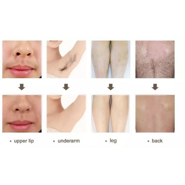 IPL SHR ND Yag Laser Machine Effective For Unwanted Hair / Tattoo Removal