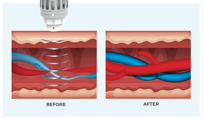 Мобильная машина Cryolipolysis жирная замерзая для размера потери веса компактного