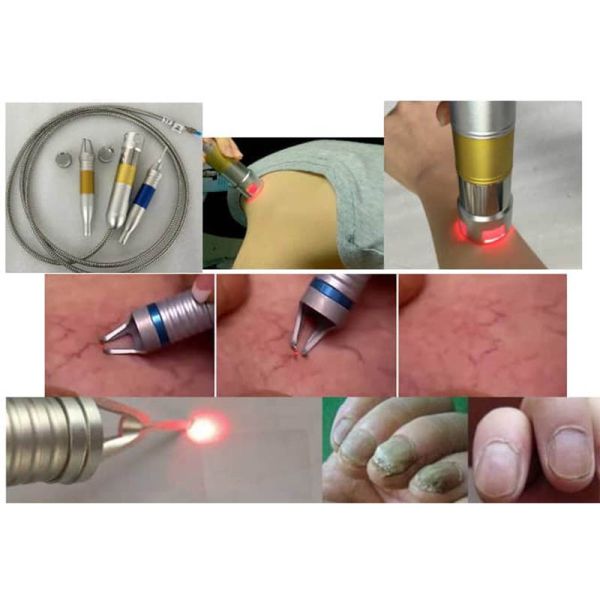 980 spider removal vascular laser vein vascular lesions removal diode laser 980nm remove leg veins