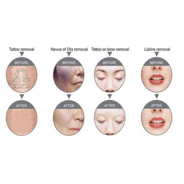 Cheap Q-switch Nd yag laser tattoo remove machine for clinics