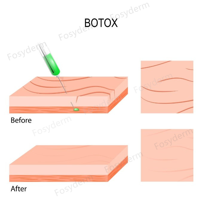 Впрыскивать тип a токсина HYAMELY Botox для того чтобы приглаживать тонкие линии на стороне