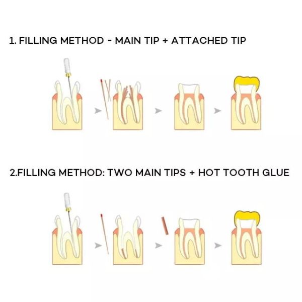 Endodontic гуттаперча указывает зубоврачебные материалы пульпирует конусности заболеванием гигиеническую 0,02