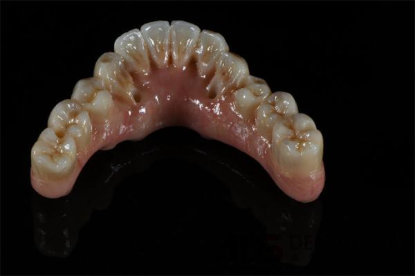OEM Cylindrical Titanium Full Bridge Dental Implants All On 4 6