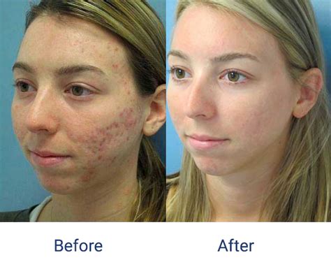 Clinic Salon Laser Beauty Equipment Multifunctional For Scar Removal